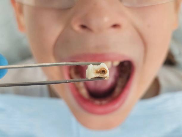 Best Emergency Tooth Extraction in Rumson, NJ